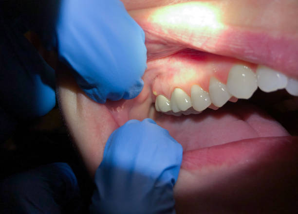 Best Emergency Broken Tooth Repair in Hellertown, PA